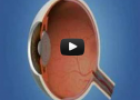 Desprendimiento de retina | Recurso educativo 81898