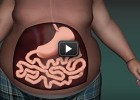 Obesity | Virtual Experiment | Gastric Bypass | Recurso educativo 682344
