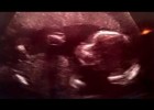 El batec del cor d'un nadó | Recurso educativo 7901013